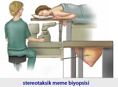 stereotaksik_meme_biyopsisi